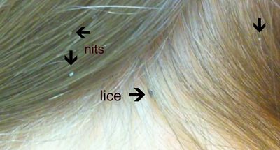 Lice Treatment - What to Know About Adult Lice