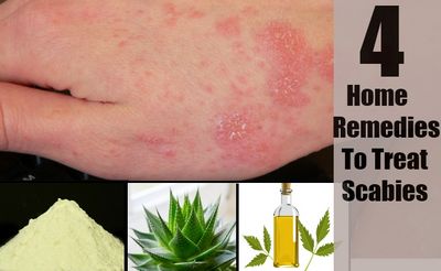 Malar Rash Remedies - How to Stop the Inflammation and Ailments