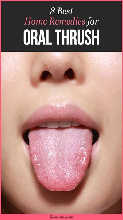 Oral Thrush in Mouth and Throat - Symptoms and Treatments