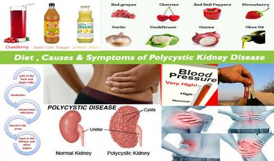 Symptoms of PCKD