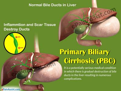 What is Primary Biliary Colic?
