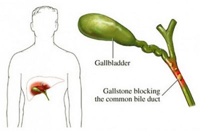 What is Primary Biliary Colic?