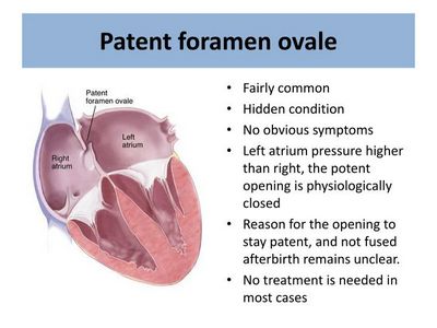 What Is the Patent Foramen Ovale?