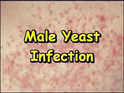 Yeast Infection in Men