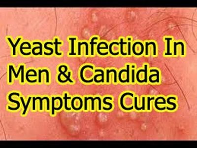 Yeast Infection in Men