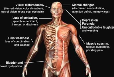 Symptoms of Multiple Sclerosis